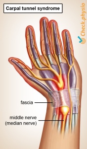 carpaltunnelsyndrome