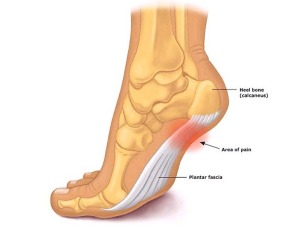 plantar-fasciitis