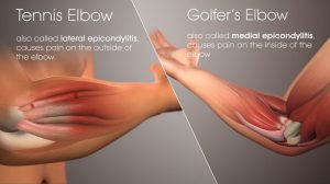 tennis-golf-elbow-1024x576